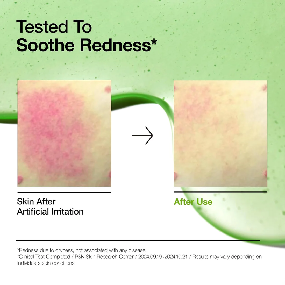 Anua Azelaic Acid 10 Hyaluron Redness Soothing Serum - Καταπραϋντικός ορός για ερεθισμένο δέρμα - Image 4